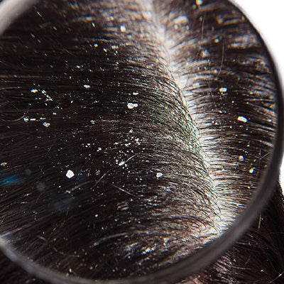 Dandruff