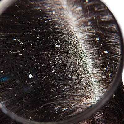 Dandruff